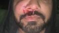 ‘A lot of Indians are targeted’: Man’s cheekbone fractured in attack by teenagers in Dublin
